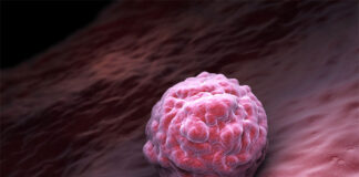 Zabieg komórkami macierzystymi